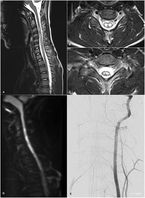 A Longitudinally Extensive Spinal Cord Lesion Restricted to Gray Matter in an Adolescent Male